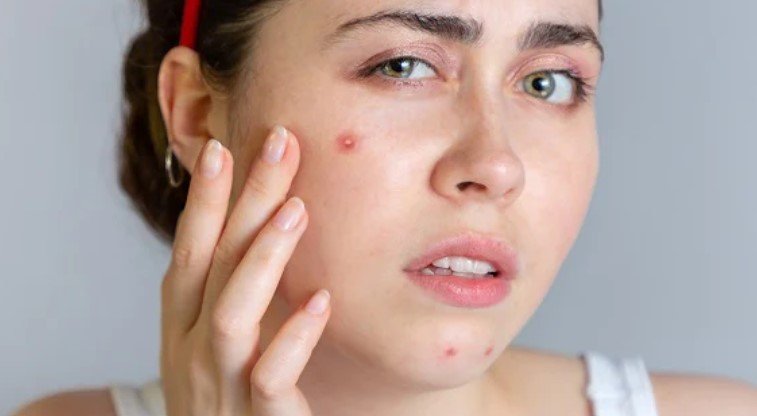 How To Stop Pimples Coming On Face