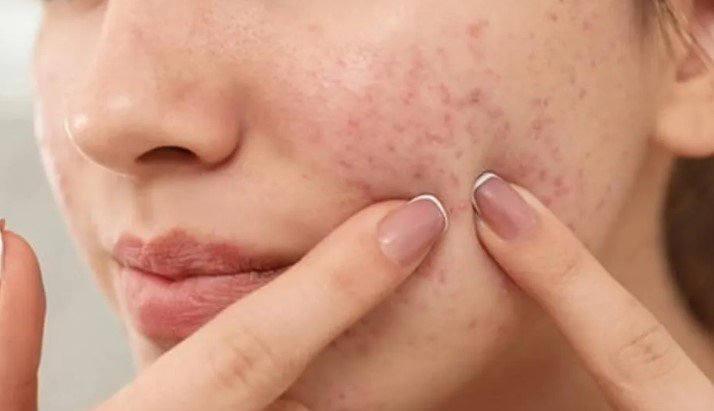 How To Stop Pimples Coming On Face At Home