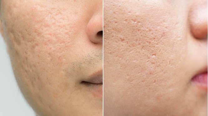 Get rid of acne black scars