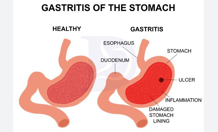 Diet plan for gastritis